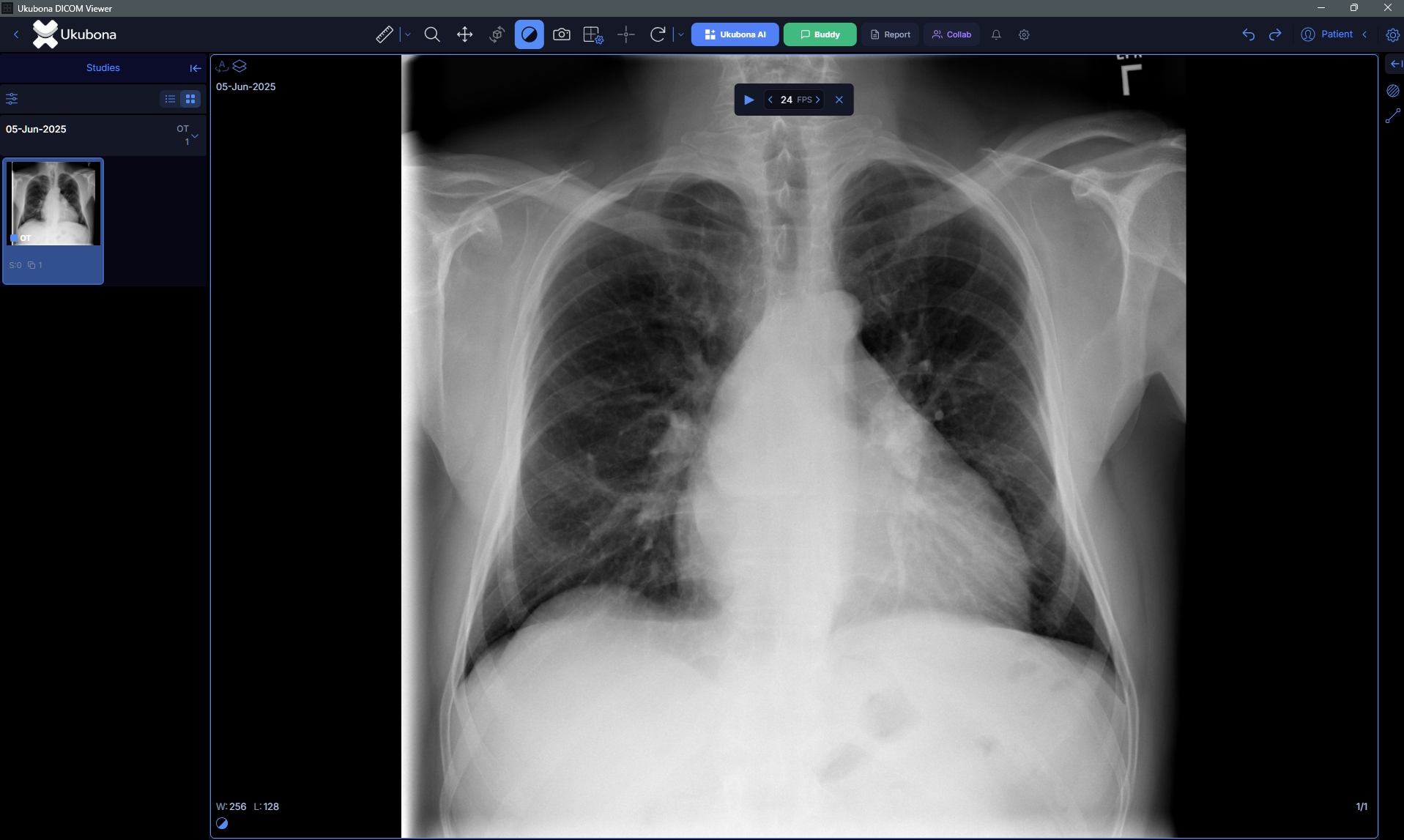 Ukubona DICOM viewer showing a CT scan with AI analysis overlay
